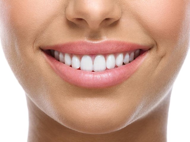 10 beneficios de las carillas dentales de composite