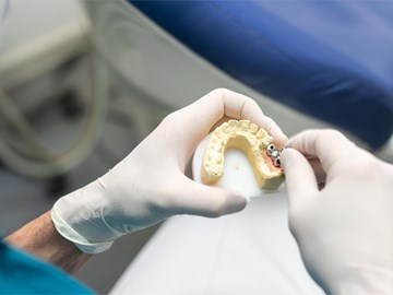 ¿A partir de que edad se pueden colocar implantes dentales?