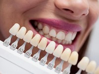 ¿A qué edad se puede hacer un blanqueamiento dental sin riesgo?