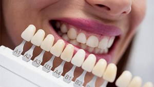 ¿A qué edad se puede hacer un blanqueamiento dental sin riesgo?