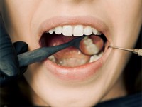 ¿Cada cuánto tiempo debo hacerme una limpieza dental?