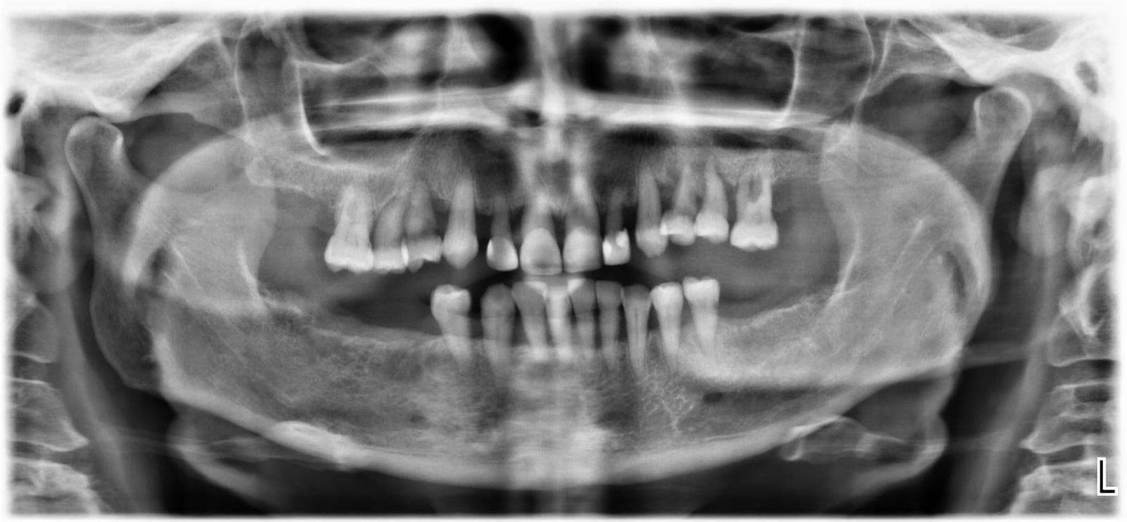 CASO CLINICO. IMPLANTES INMEDIATOS POST EXTRACCION CON PROTESIS REMOVIBLE INMEDIATA  - Imagen 12