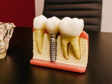 ¿Cómo debemos cuidar nuestros implantes dentales?