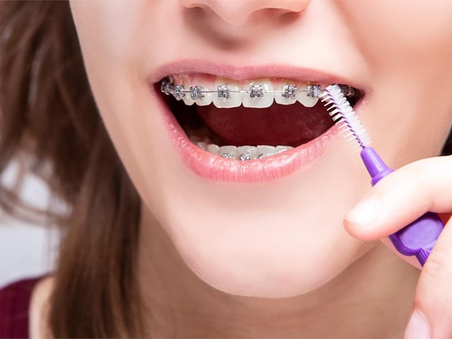 ¿Cómo me lavo los dientes con brackets?