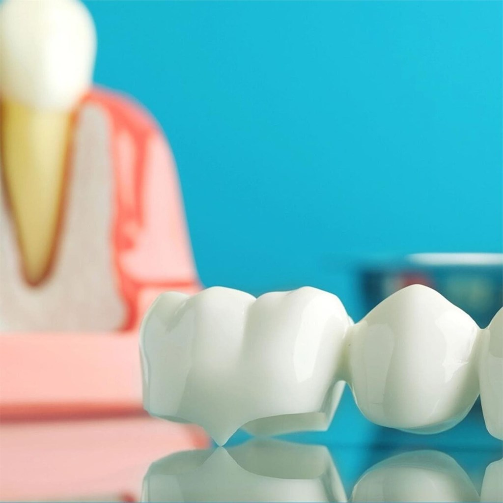 ¿Cuánto tiempo duran los implantes dentales?