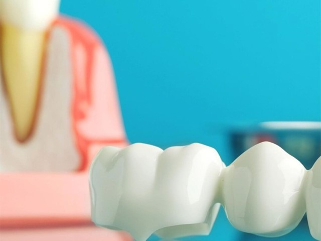 ¿Cuánto tiempo duran los implantes dentales?