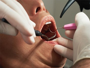 Diferencias entre un empaste dental y una endodoncia