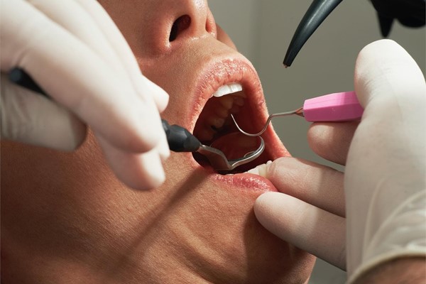 Diferencias entre un empaste dental y una endodoncia