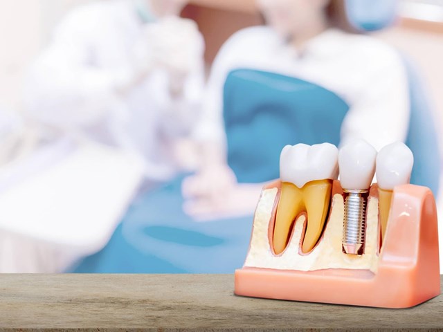 Especialistas en implantes dentales