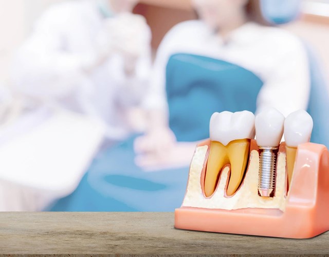 Especialistas en implantes dentales