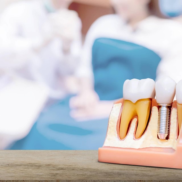 Especialistas en implantes dentales