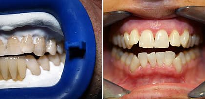 Antes y después tratamientos de estética dental