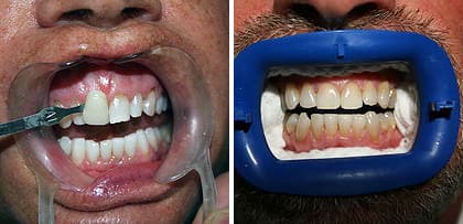 Antes y después tratamientos de estética dental