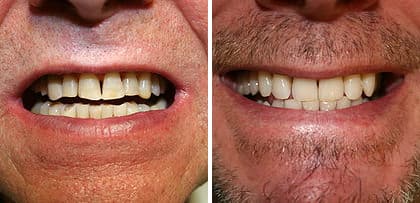 Antes y después tratamientos de estética dental