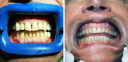 Antes y después tratamientos de estética dental