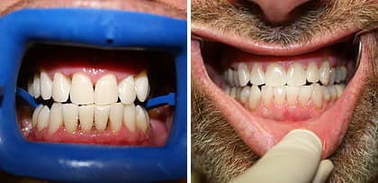 Antes y después tratamientos de estética dental