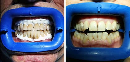 Antes y después tratamientos de estética dental