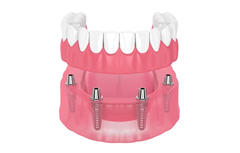 Implante dental total