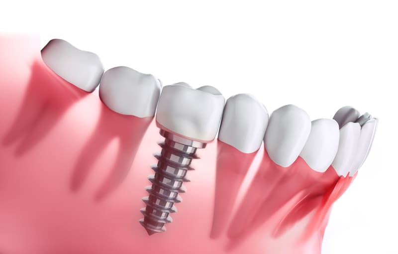 Implante dental de un solo diente