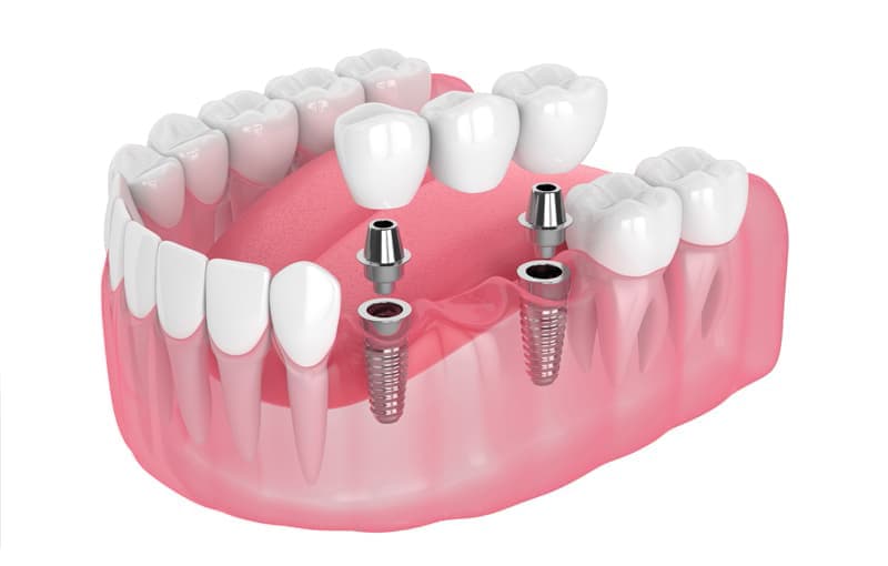 Sustitución de varias piezas dentales
