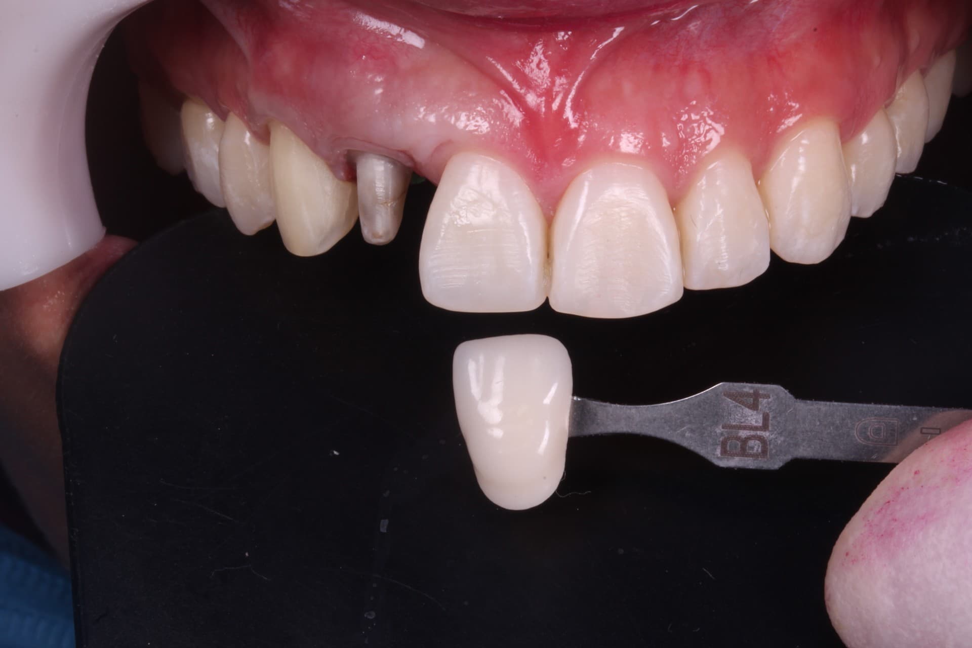 Carillas dentales en Vigo y Baiona