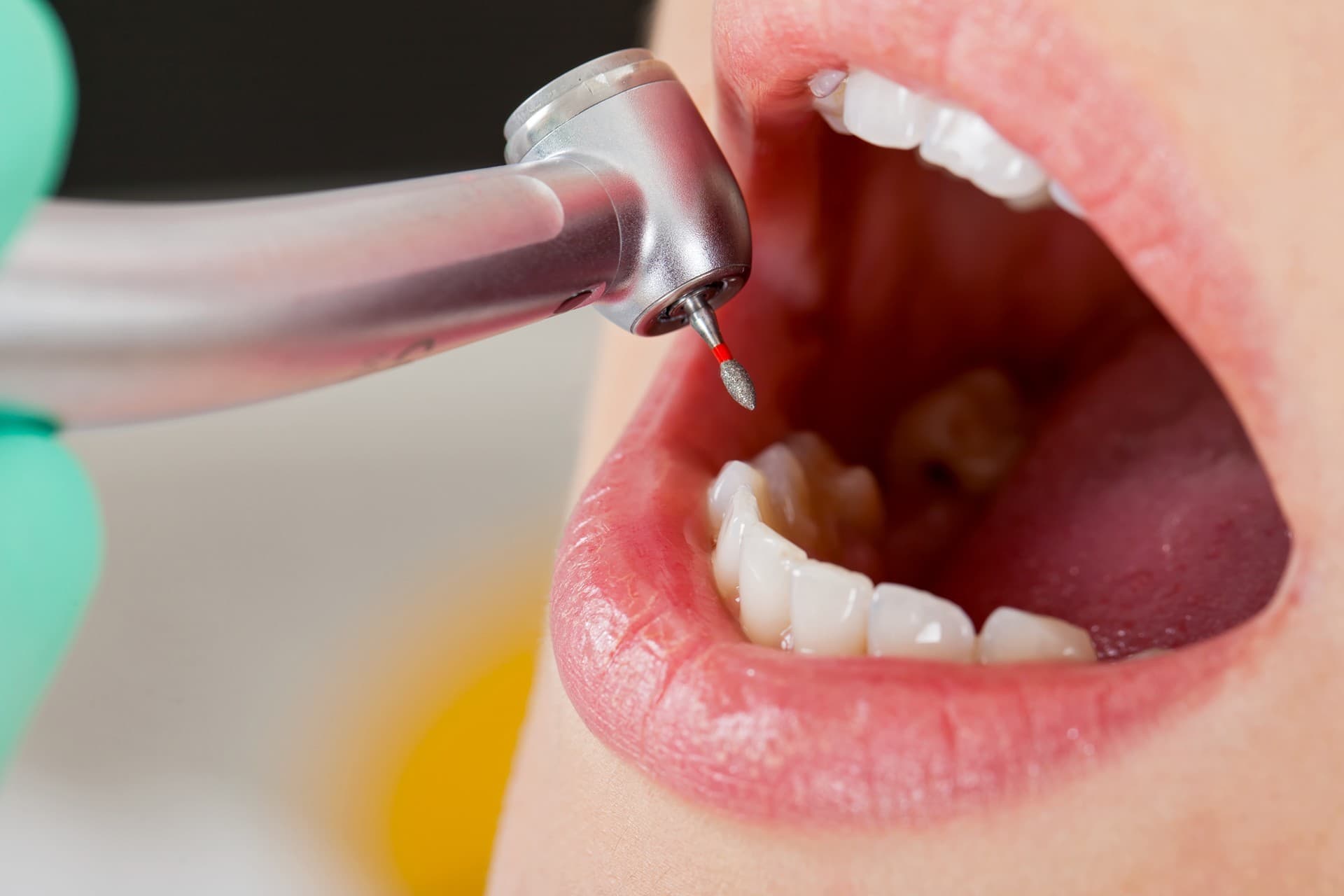 Tratamiento de endodoncia en Vigo y Baiona