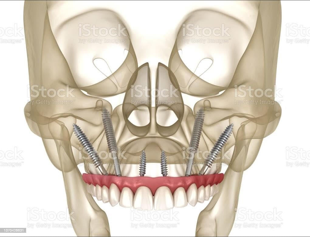 IMPLANTES ZIGOMÁTICOS. UNA SOLUCIÓN VIABLE. - Imagen 1