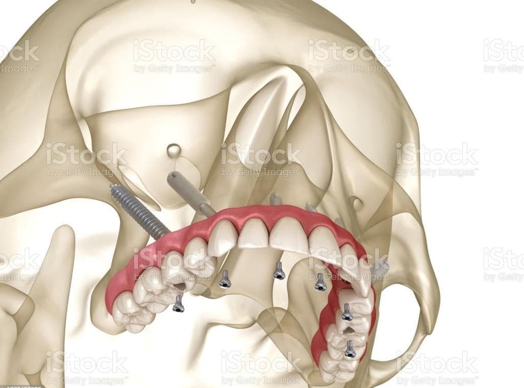 IMPLANTES ZIGOMÁTICOS. UNA SOLUCIÓN VIABLE. - Imagen 2