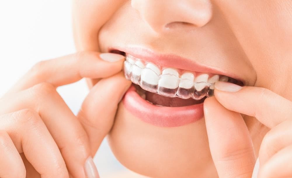 ¿La ortodoncia invisible es muy cara?