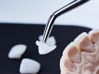 ¿Las carillas se notan? Todo sobre el aspecto natural del resultado