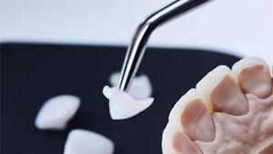 ¿Las carillas se notan? Todo sobre el aspecto natural del resultado