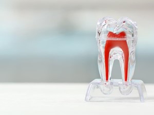 ¿Las endodoncias duelen? 