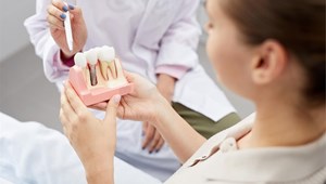 Mitos sobre los implantes dentales