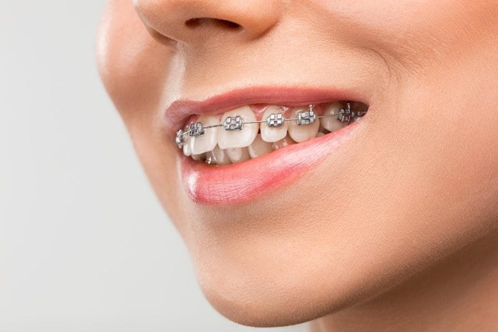 ¿Para qué sirve un tratamiento de ortodoncia?