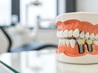 ¿Por qué es importante reemplazar un diente perdido lo antes posible con un implante dental?