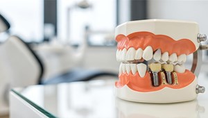 ¿Por qué es importante reemplazar un diente perdido lo antes posible con un implante dental?