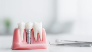 ¿Puedo ponerme implantes si tengo diabetes?