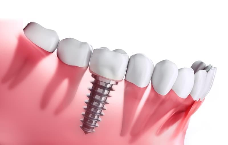 ¿Se puede poner implante en un único diente?