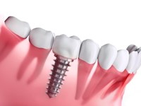 ¿Se puede poner implante en un único diente?