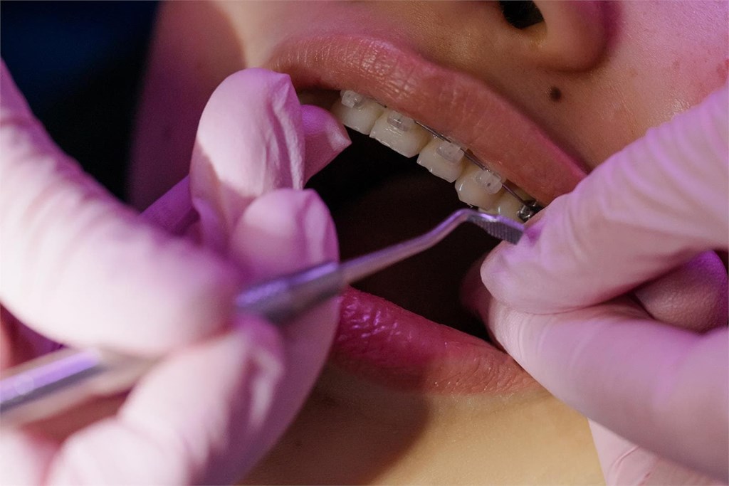Tipos de ortodoncia: características principales de cada uno de ellos