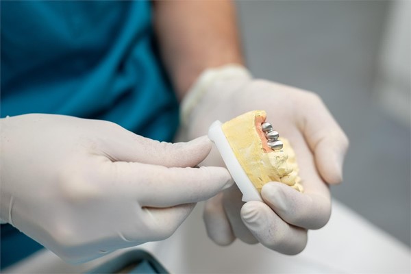 Tipos y características de implantes dentales