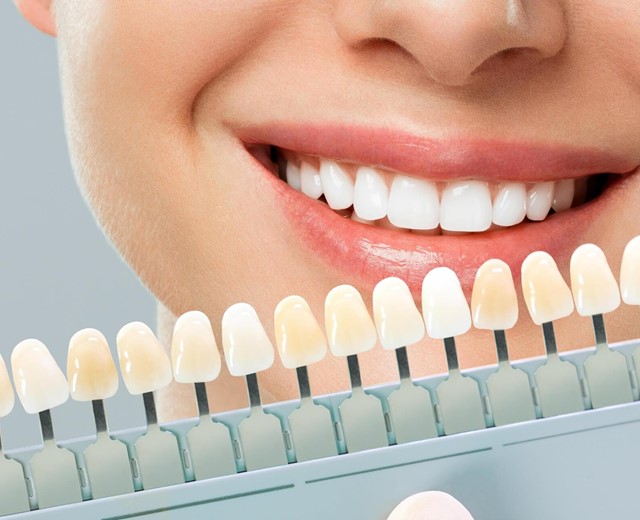 Tratamientos de blanqueamiento dental en Vigo y Baiona