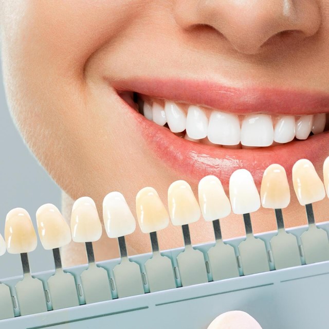 Tratamientos de blanqueamiento dental en Vigo y Baiona